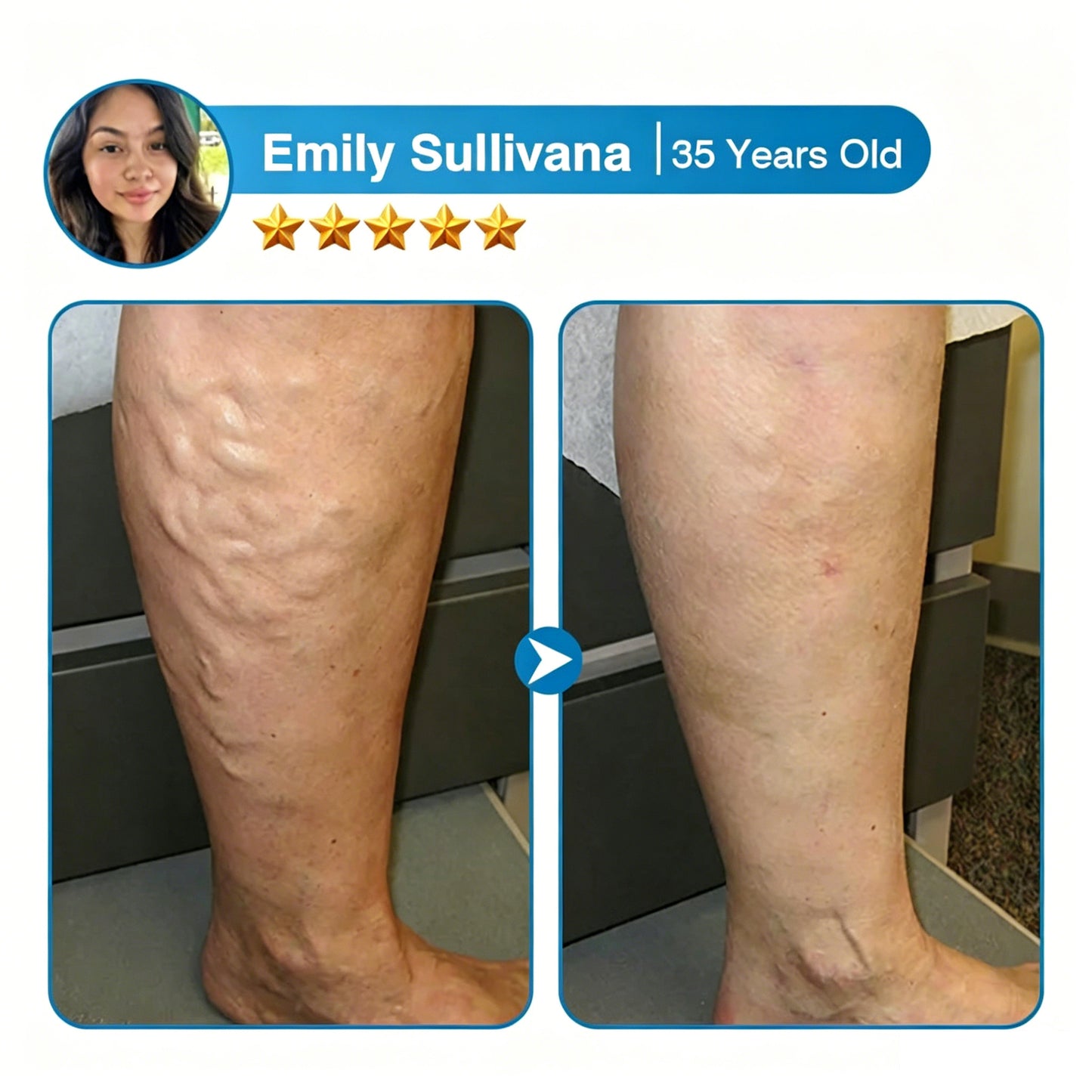🇨🇦🏆✅️🏃Femscoop® VeinRepair Microneedle Patch Roll⚡Instant Relief, Long-Term Results