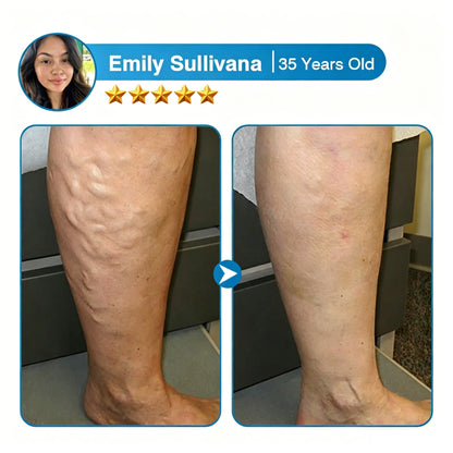 🇨🇦🏆✅️🏃Femscoop® VeinRepair Microneedle Patch Roll⚡Instant Relief, Long-Term Results