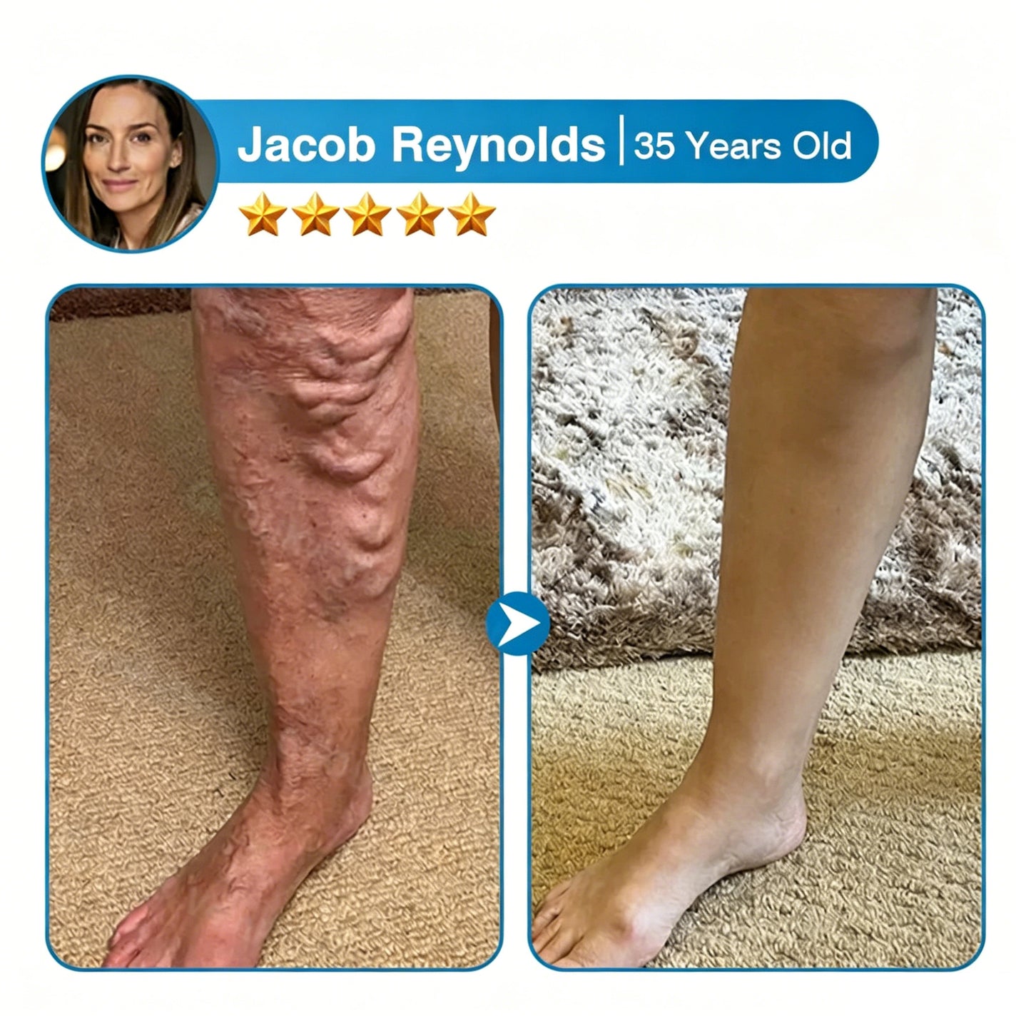 🇨🇦🏆✅️🏃Femscoop® VeinRepair Microneedle Patch Roll⚡Instant Relief, Long-Term Results