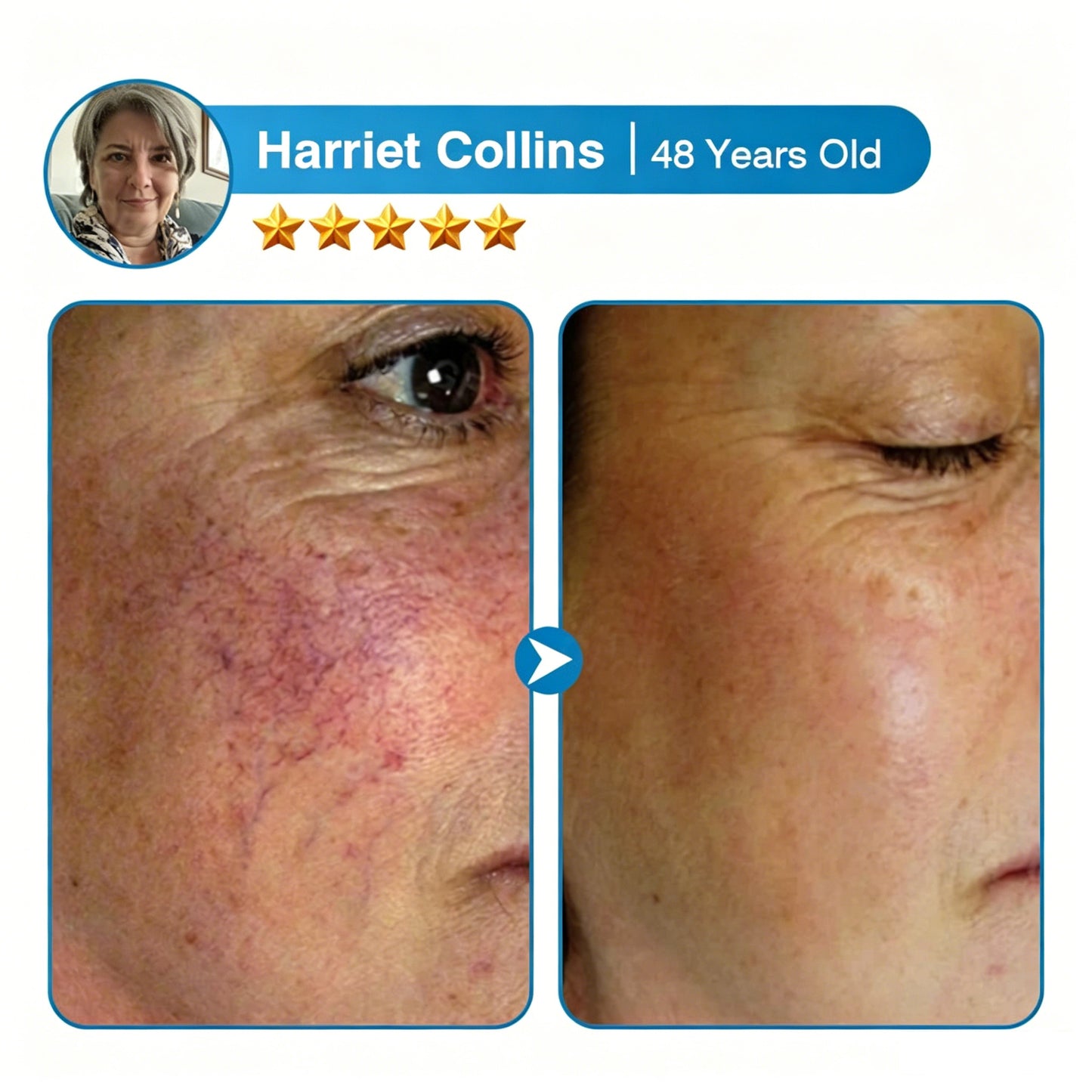 🇨🇦🏆✅️🏃Femscoop® VeinRepair Microneedle Patch Roll⚡Instant Relief, Long-Term Results