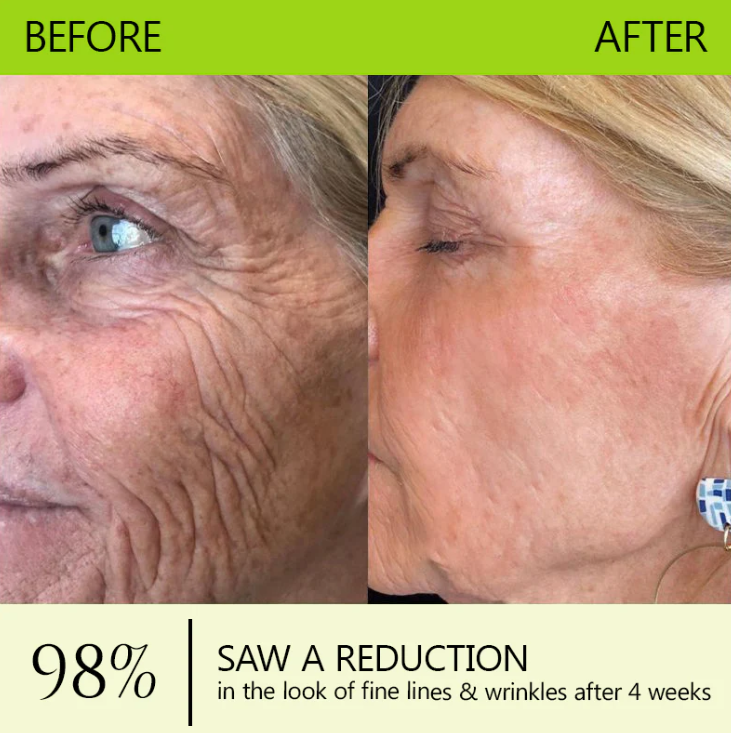 [🔥Last Day 70% OFF]Femscoop™ Botox & Retinol Shot - Eraser for Deep Wrinkles, Sagging Jowls & Puffy Eyes