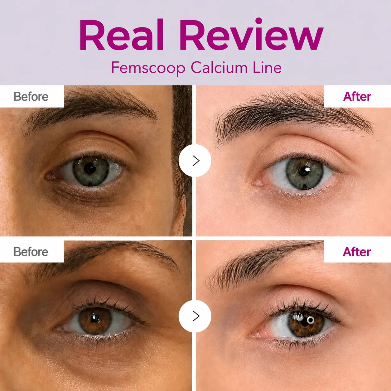 Femscoop Korean Calcium Eye Cream: Visibly Erase Stubborn Dark Spots, Puffy Eye Bags & Dark Circles—Claim Your 50% OFF Today Before It’s Gone!