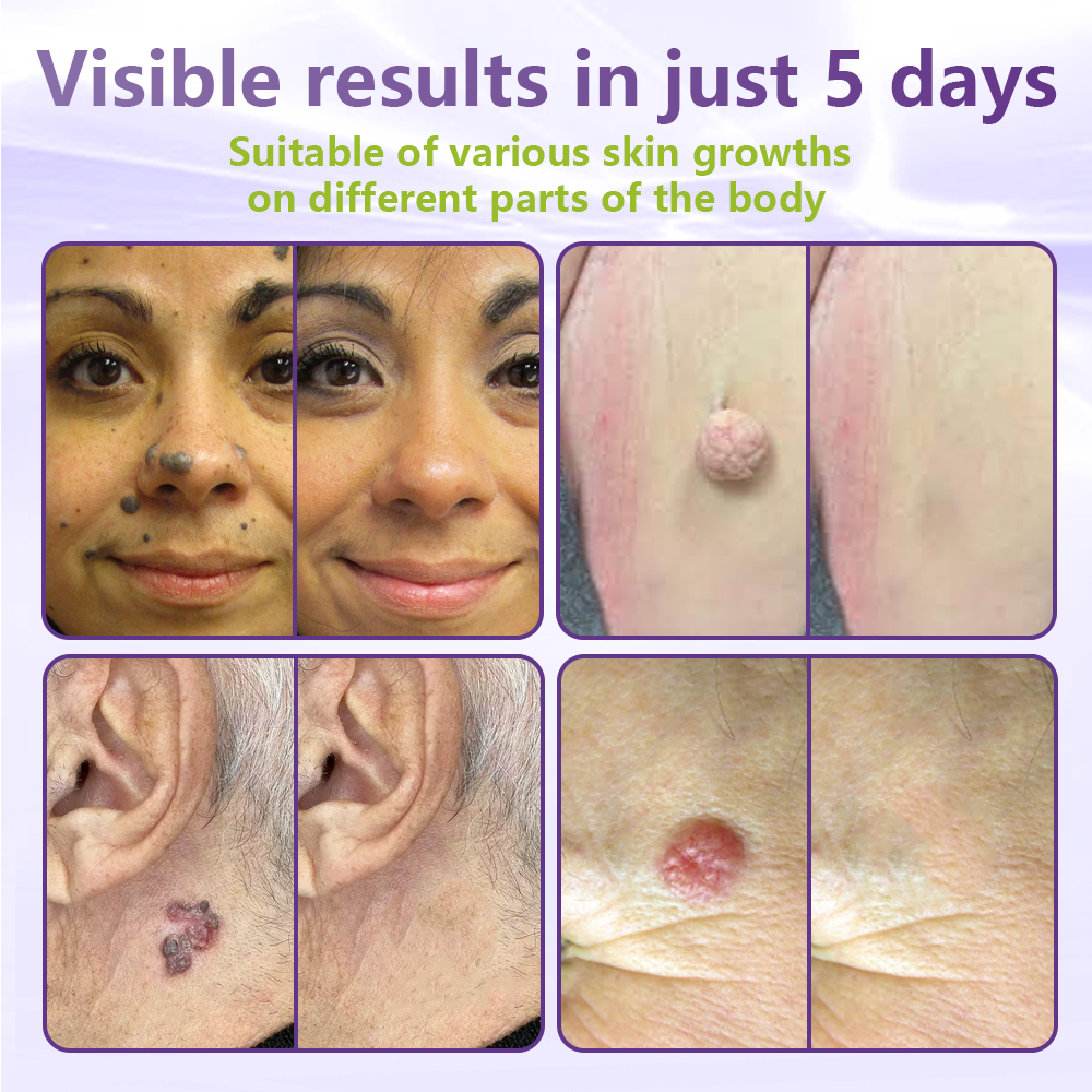 Miretha™Soluble Microneedle Botanical Skin Tag Removal Patch