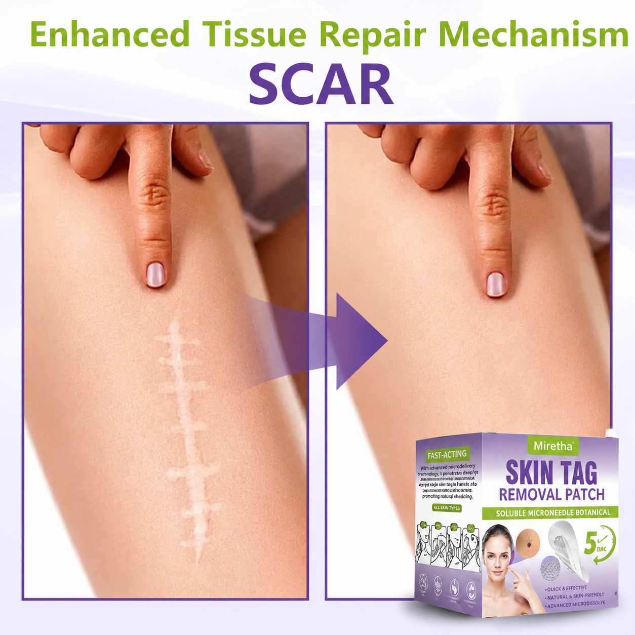 Miretha™Soluble Microneedle Botanical Skin Tag Removal Patch