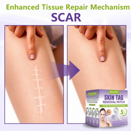 Miretha™Soluble Microneedle Botanical Skin Tag Removal Patch