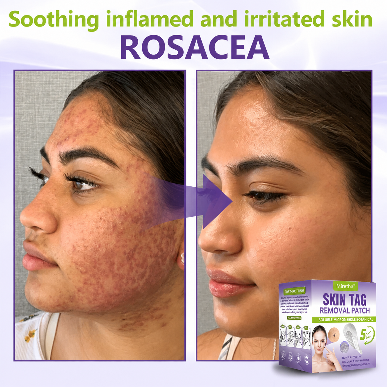 Miretha™Soluble Microneedle Botanical Skin Tag Removal Patch