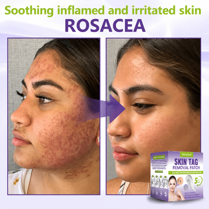 Miretha™Soluble Microneedle Botanical Skin Tag Removal Patch