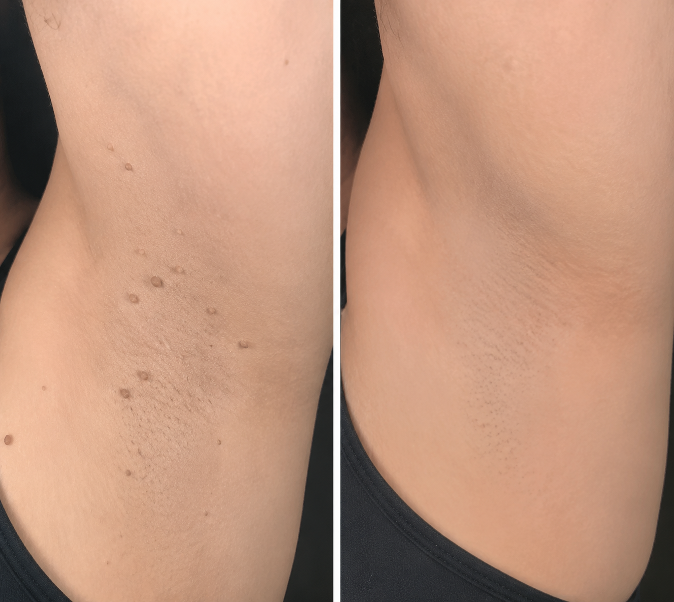 MYLUREN™2-in-1 Microneedle & Hydrocolloid Patch🍀| Removes Raised Moles, Acne, Flat Warts & Skin Tags | Helps Improve Wrinkles, Scars & Blemishes | Invisible Patches for Face & Body