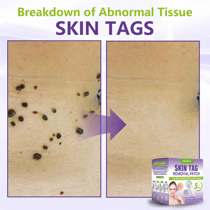 Miretha™Soluble Microneedle Botanical Skin Tag Removal Patch